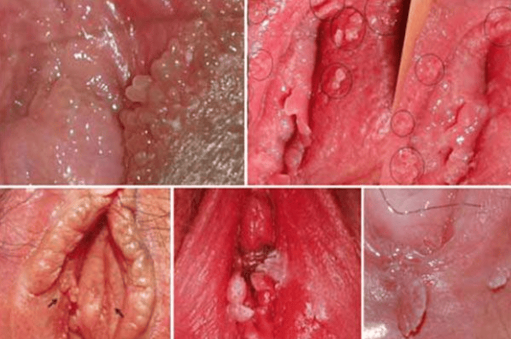     Bệnh sùi mào gà ở nữ 