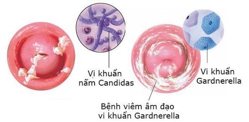 Viêm âm hộ do vi khuẩn phổ biến hơn so với nhiễm trùng nấm men